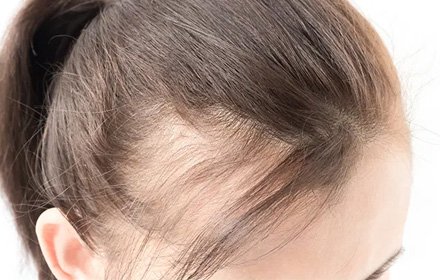Hair Regrowth Treatment in Panipat