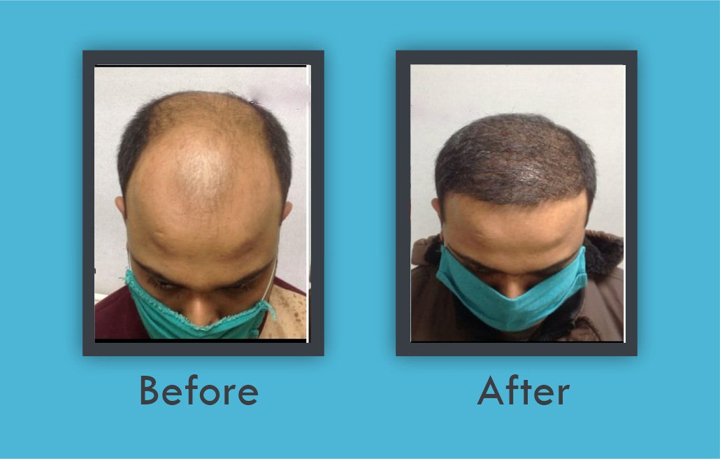 Before After- Eyebrow Hair Transplantation