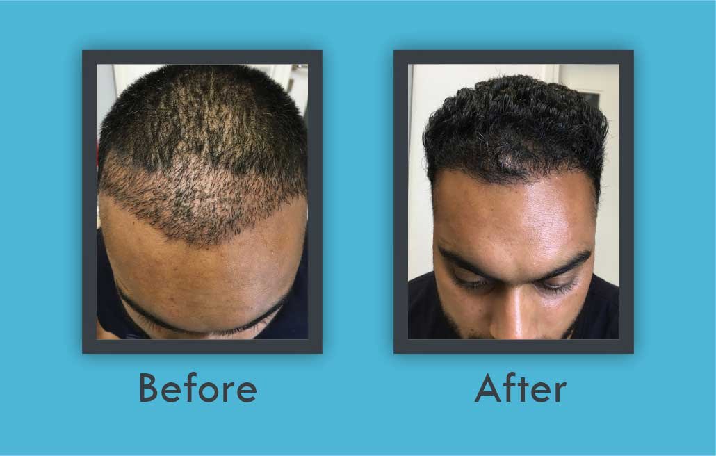 Before After - Hair Transplantation in Panipat
