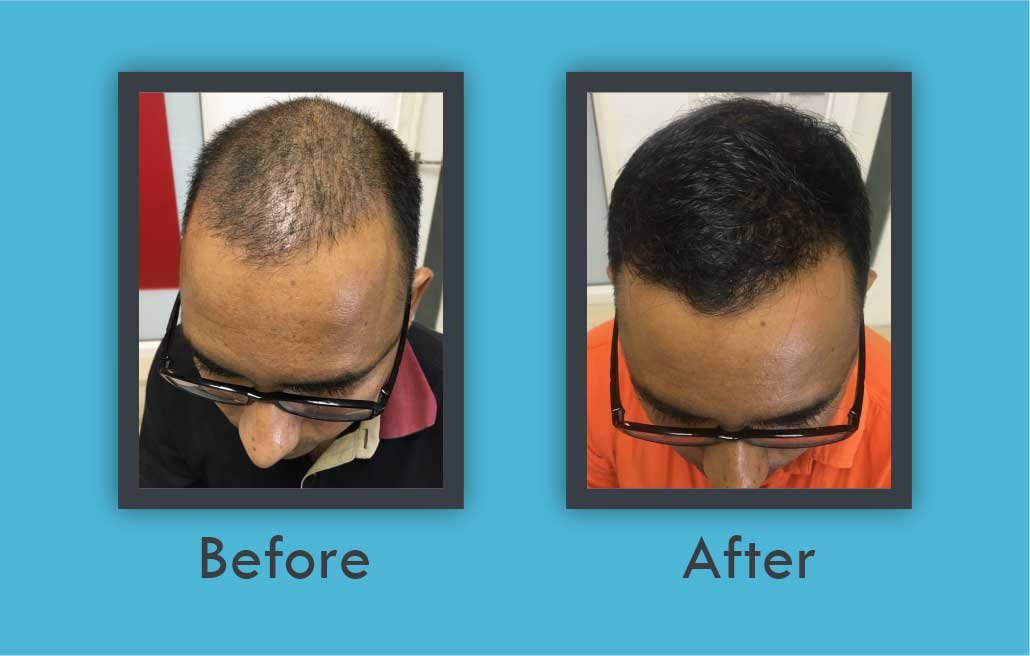 Before After -Best Hair Transplantation Doctor