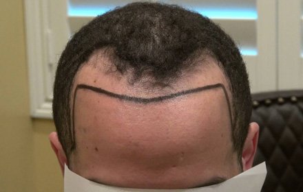 Hairline Reconstruction in Panipat